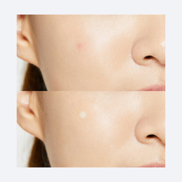 Acne Pimple Master Patch - Original Care