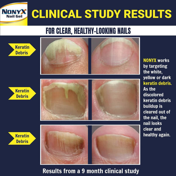NONYX Fungal Nail Clarifying Gel | Clinically Proven for Discolored, Thick, Brittle, Yellow, Lifted, and other signs of Fungus-Damaged Toenails | 90%