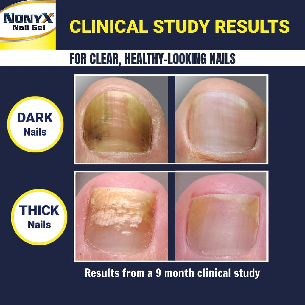 NONYX Fungal Nail Clarifying Gel | Clinically Proven for Discolored, Thick, Brittle, Yellow, Lifted, and other signs of Fungus-Damaged Toenails | 90%