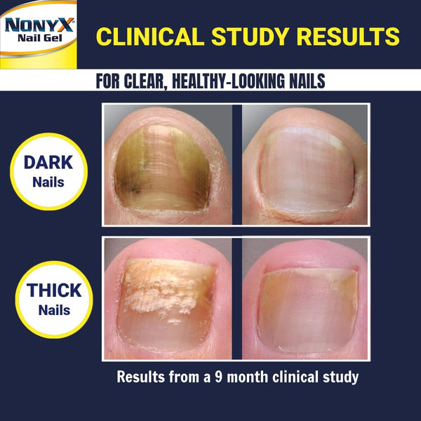 NONYX Fungal Nail Clarifying Gel | Clinically Proven for Discolored, Thick, Brittle, Yellow, Lifted, and other signs of Fungus-Damaged Toenails | 90%