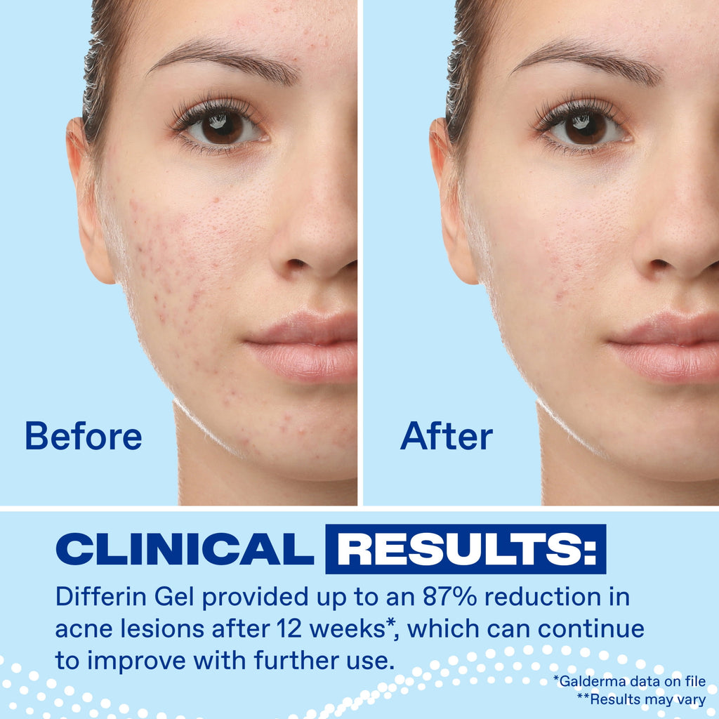 Differin Prescription-Strength Retinoid Acne Treatment Gel for Face with 0.1% Adapalene, Clears & Prevents Acne, Fragrance-Free, 15g Tube​