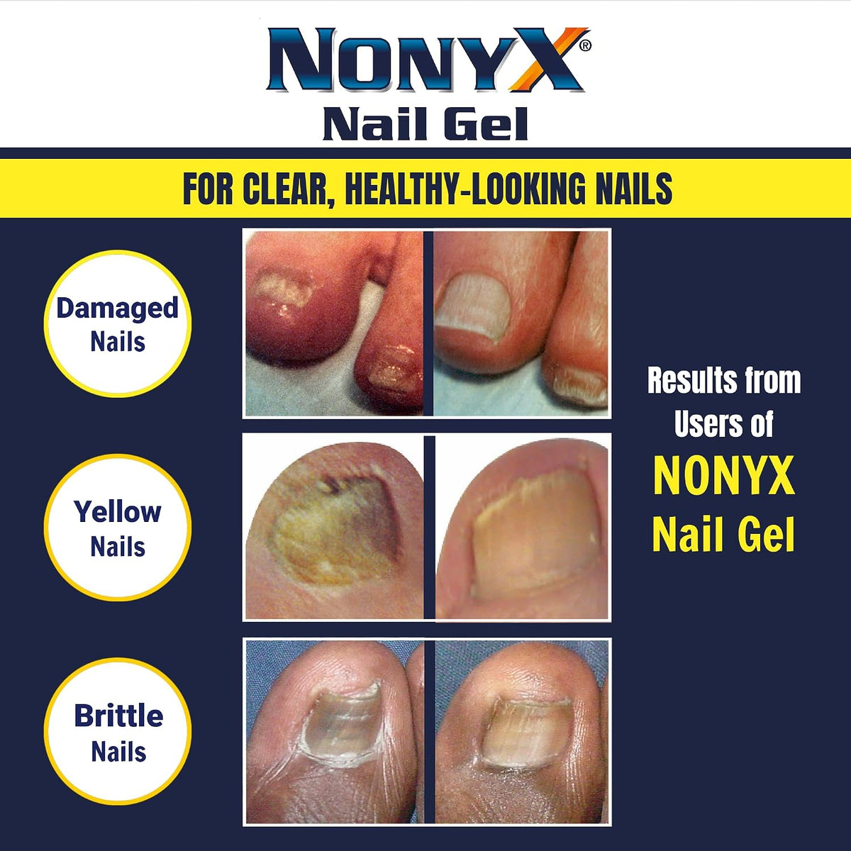 NONYX Fungal Nail Clarifying Gel | Clinically Proven for Discolored, Thick, Brittle, Yellow, Lifted, and other signs of Fungus-Damaged Toenails | 90%