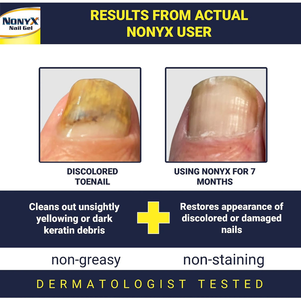 NONYX Fungal Nail Clarifying Gel | Clinically Proven for Discolored, Thick, Brittle, Yellow, Lifted, and other signs of Fungus-Damaged Toenails | 90%