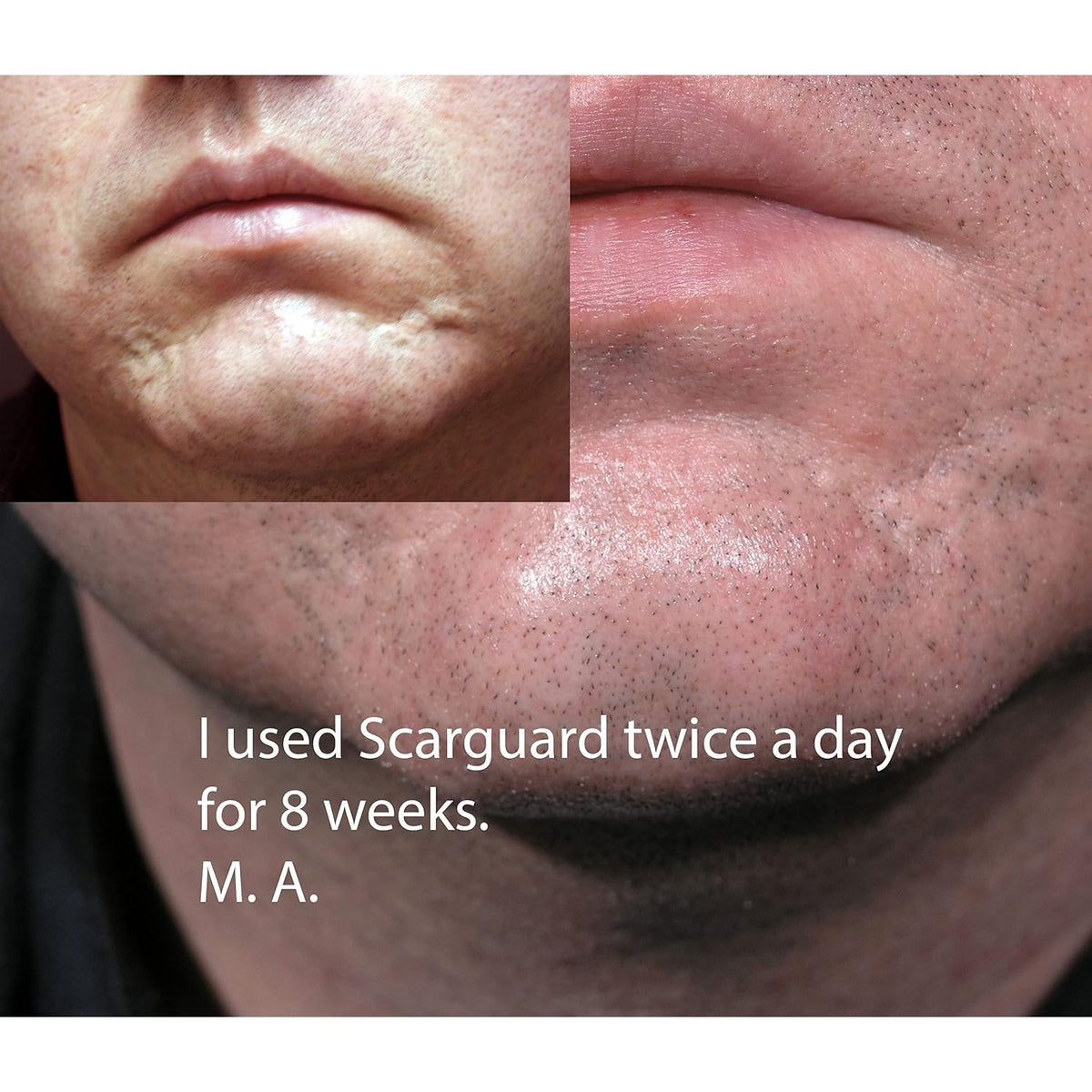 Scarguard - Invisible Brush-On Silicone Sheet with Vitamin E - Scar Removal for Keloids, Burn Scars, Surgery Scars, Stitches, Cuts - No Ugly Scar